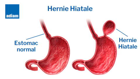 Maladie De L’Estomac Hernie Hiatale – UMMLR