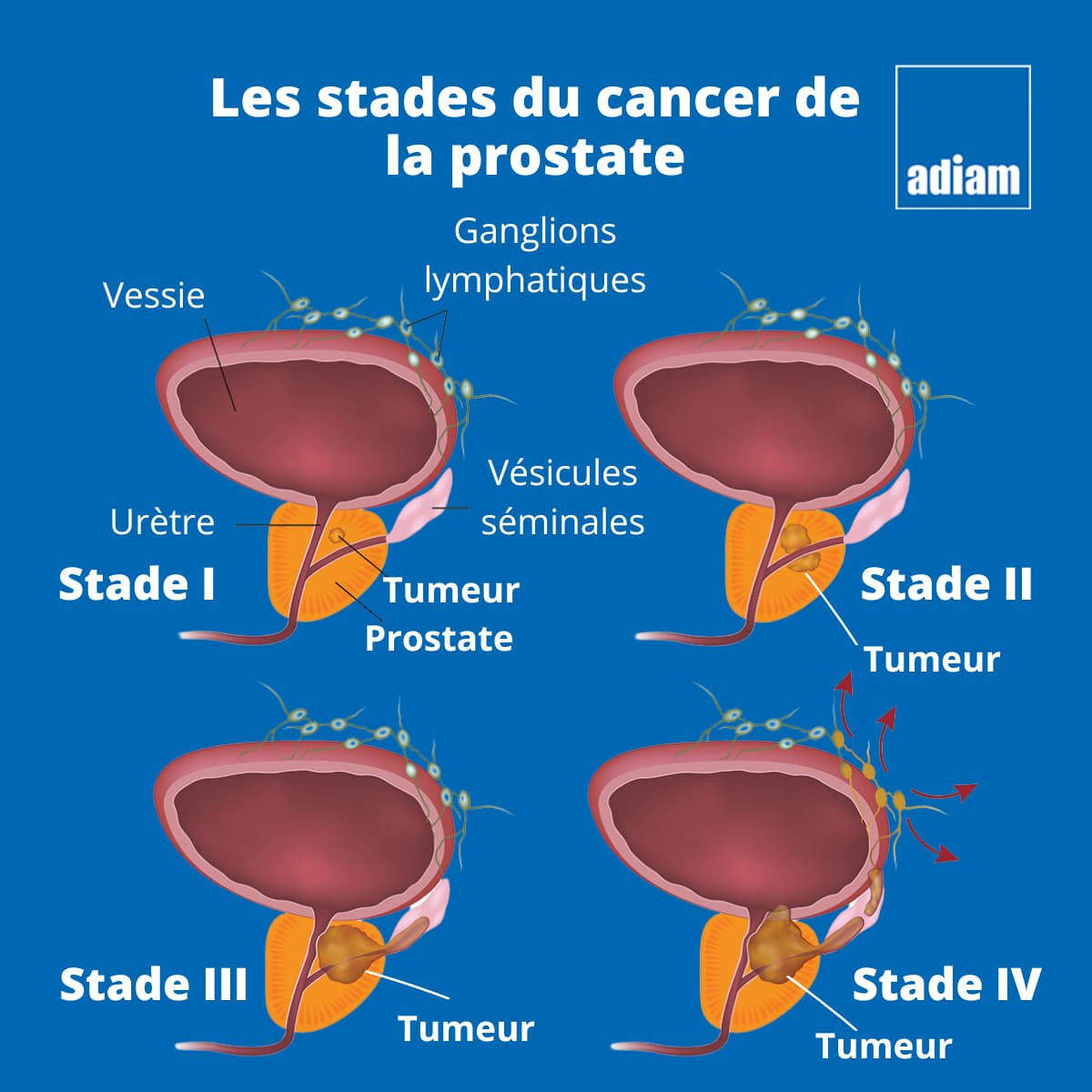 stades-du-cancer-de-la-prostate-prostate-cancer-statistics-for-2024